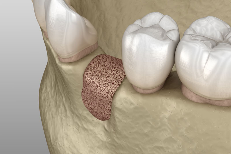 image graphic of bone graft